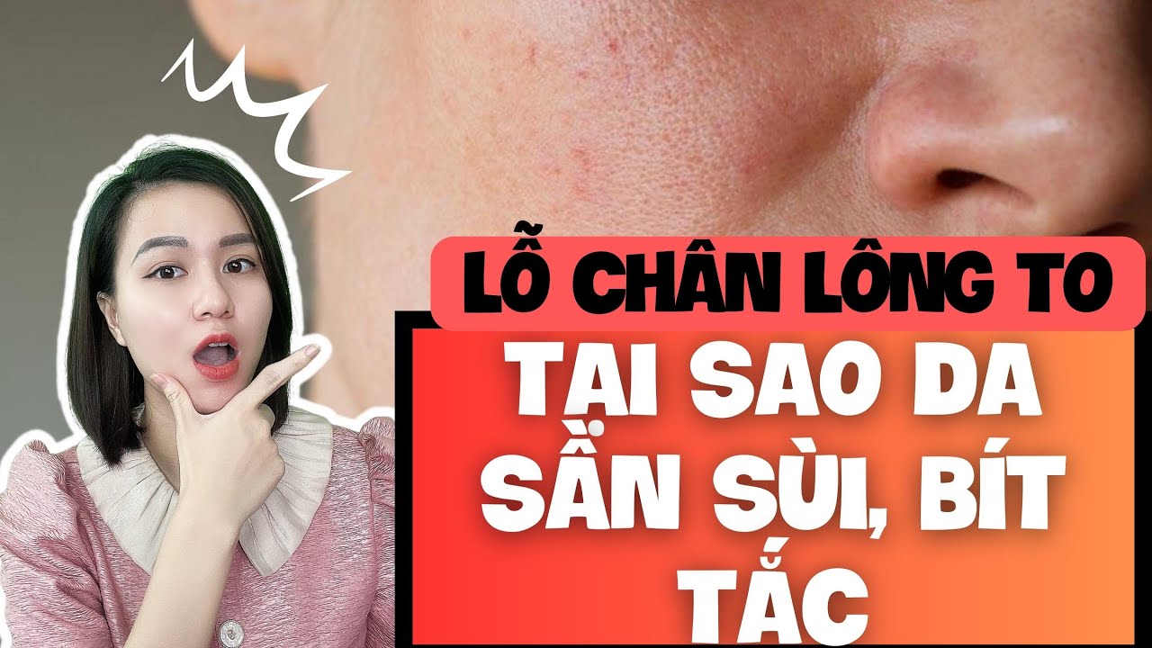 Tiết lộ lý do Vì sao da sần sùi, lỗ chân lông to, bít tắc | Nguyễn Mai Hương