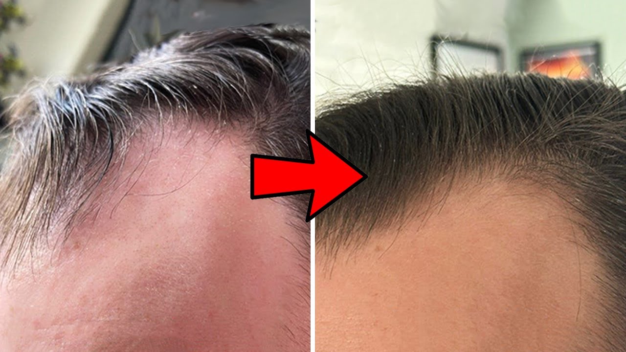 Su Pelo Vuelve De La Tumba Sin Injerto Capilar