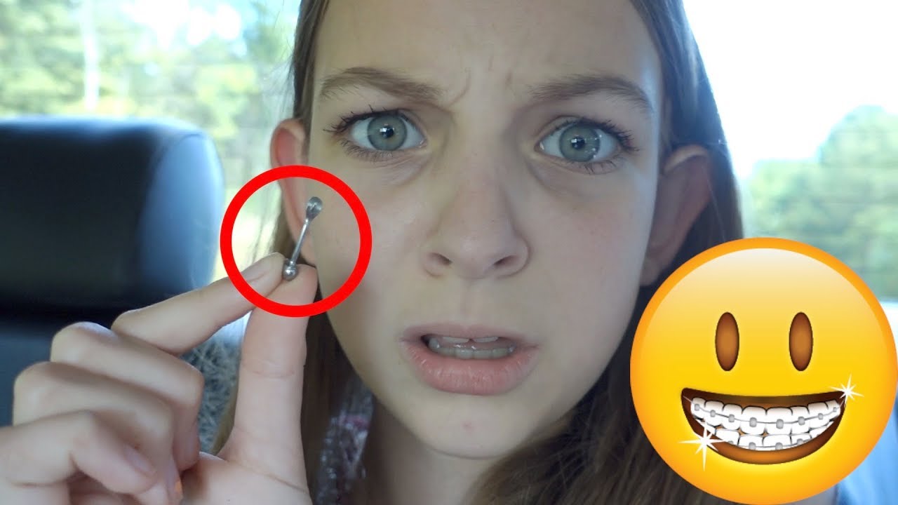 BRACES VLOG | SHE BROKE HER BRACES!