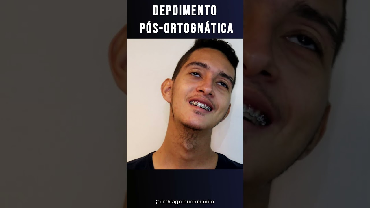 Cirurgia ortognática - Grave Assimetria pós- 2 meses - Depoimento Diego
