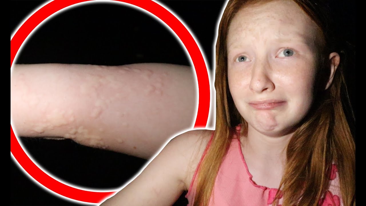 ESMÉ FELL DOWN A DITCH INTO STINGING NETTLES!! (CRAZY SKIN REACTION!!)