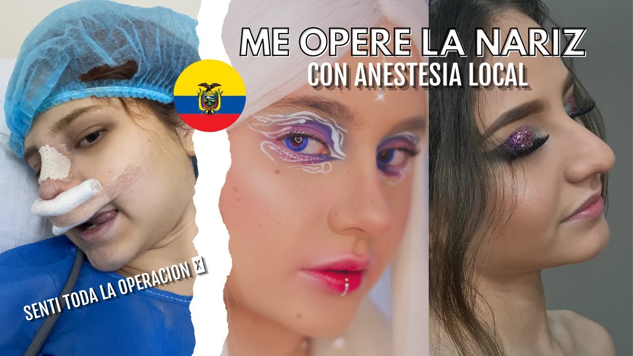 ¡ME OPERÉ LA NARIZ EN ECUADOR🇪🇨! | Mi experiencia con anestesia local con sedación.