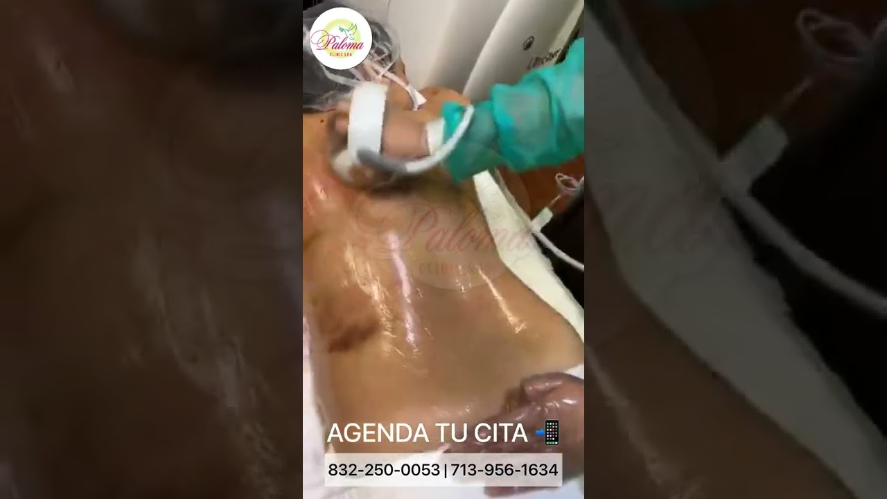 Reducción de Grasa Localizada en Espalda con Vacumterapia y Radiofrecuencia en Paloma Clinic Spa