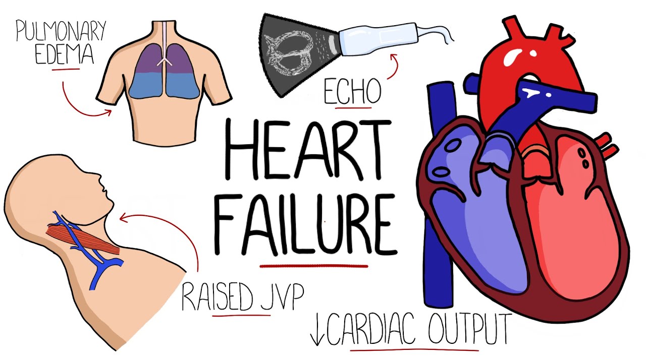 Объяснение сердечной недостаточности: HFrEF против HFpEF (систолическая и диастолическая сердечна...