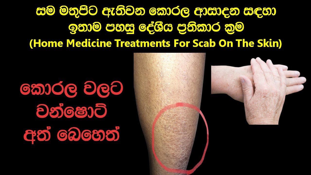 කොරල සුව කරන පහසු අත් බෙහෙත් | Korala Walata Ath Beheth Sinhala