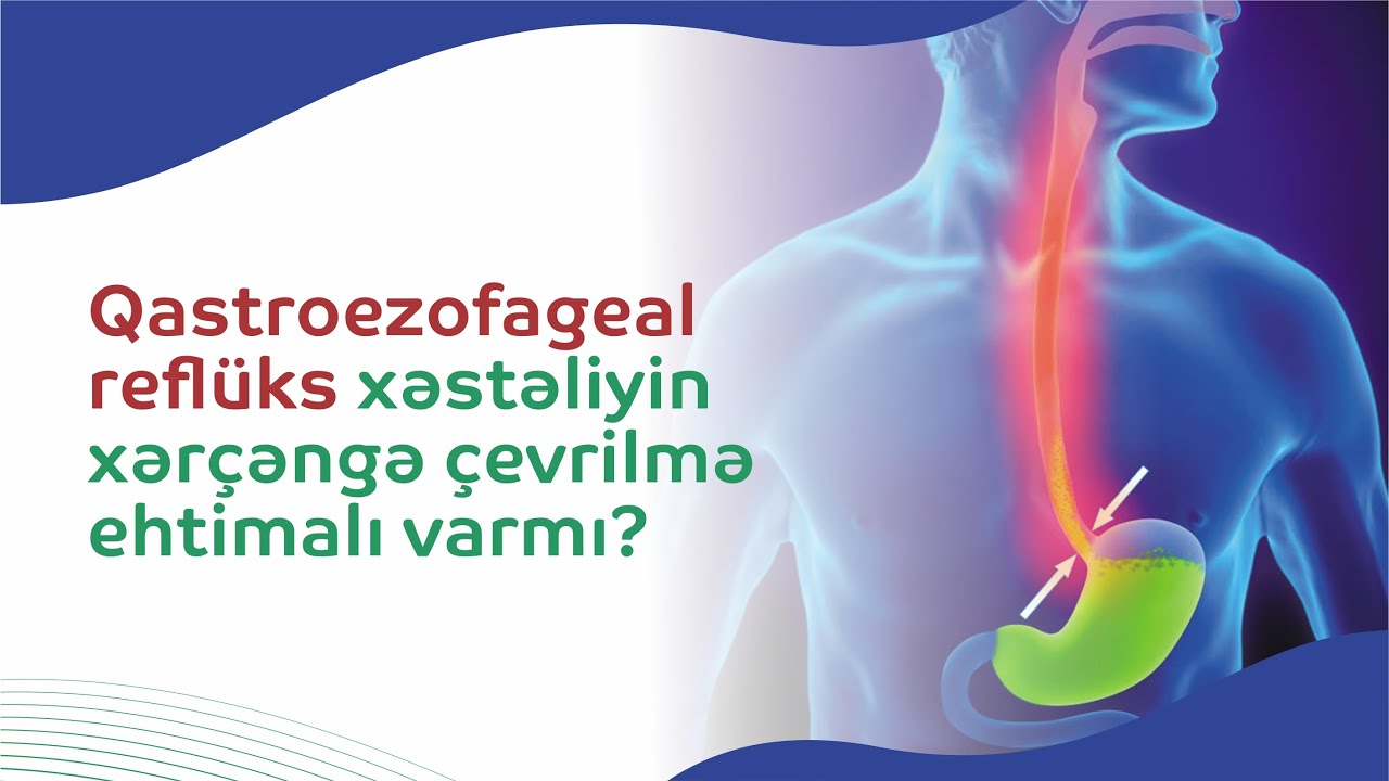 Qastroezofageal reflüks xəstəliyinin tək müalicə üsulu cərrahi müdaxilə deyil - Ətraflı Videoda