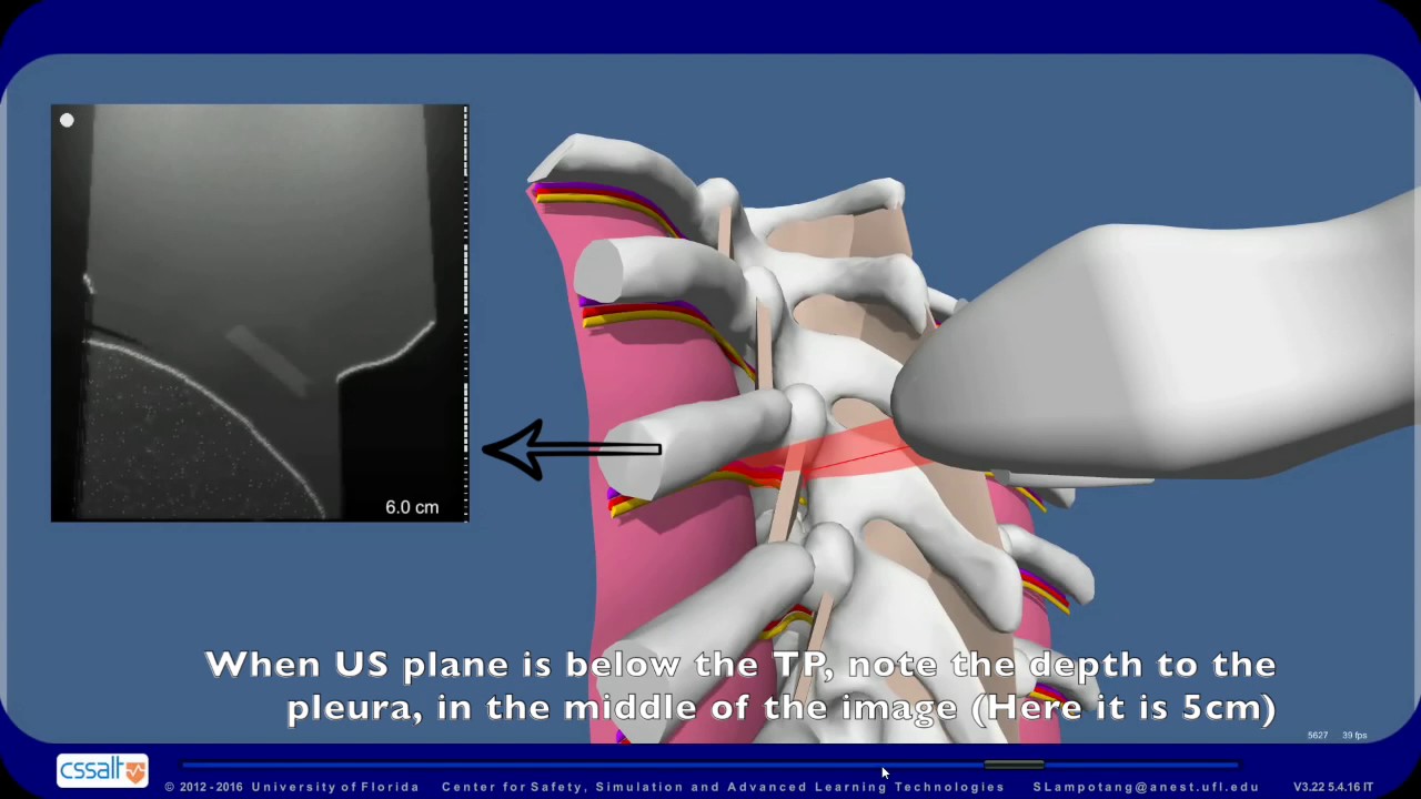 Ultrasound Assisted Thoracic Paravertebral Nerve Block Part 1