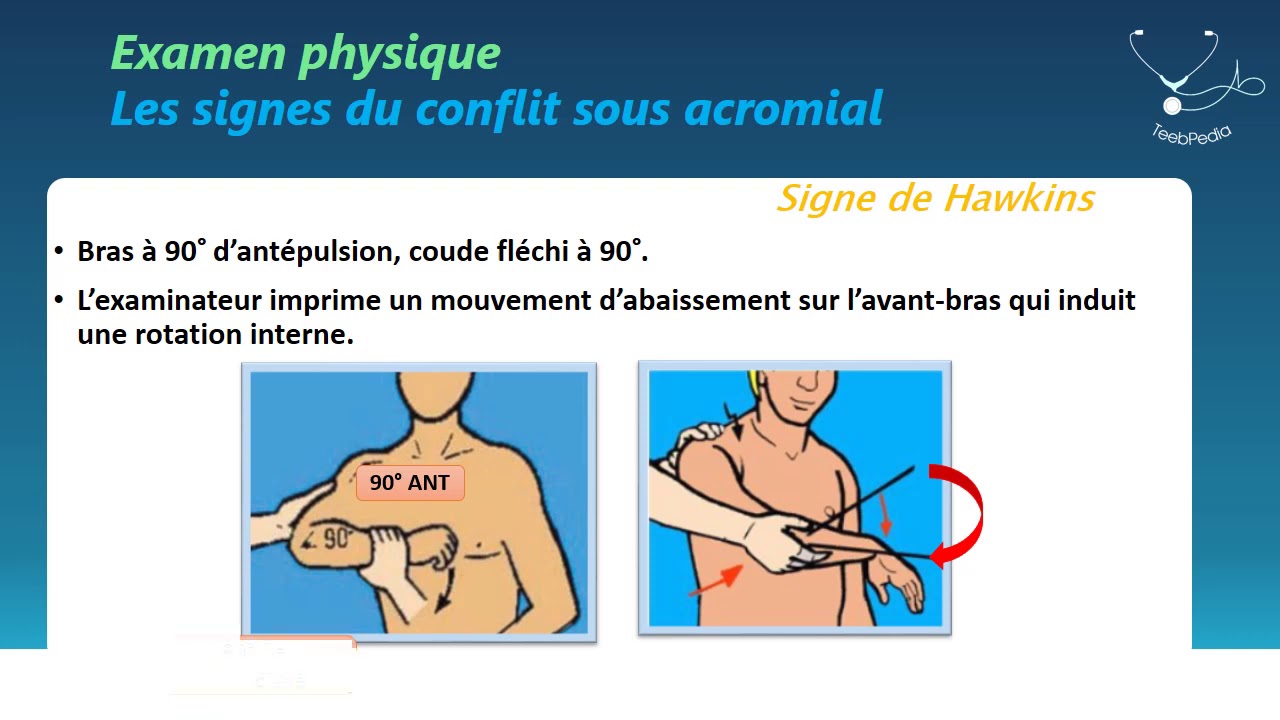 CAT devant une épaule douloureuse - Dr Berkache