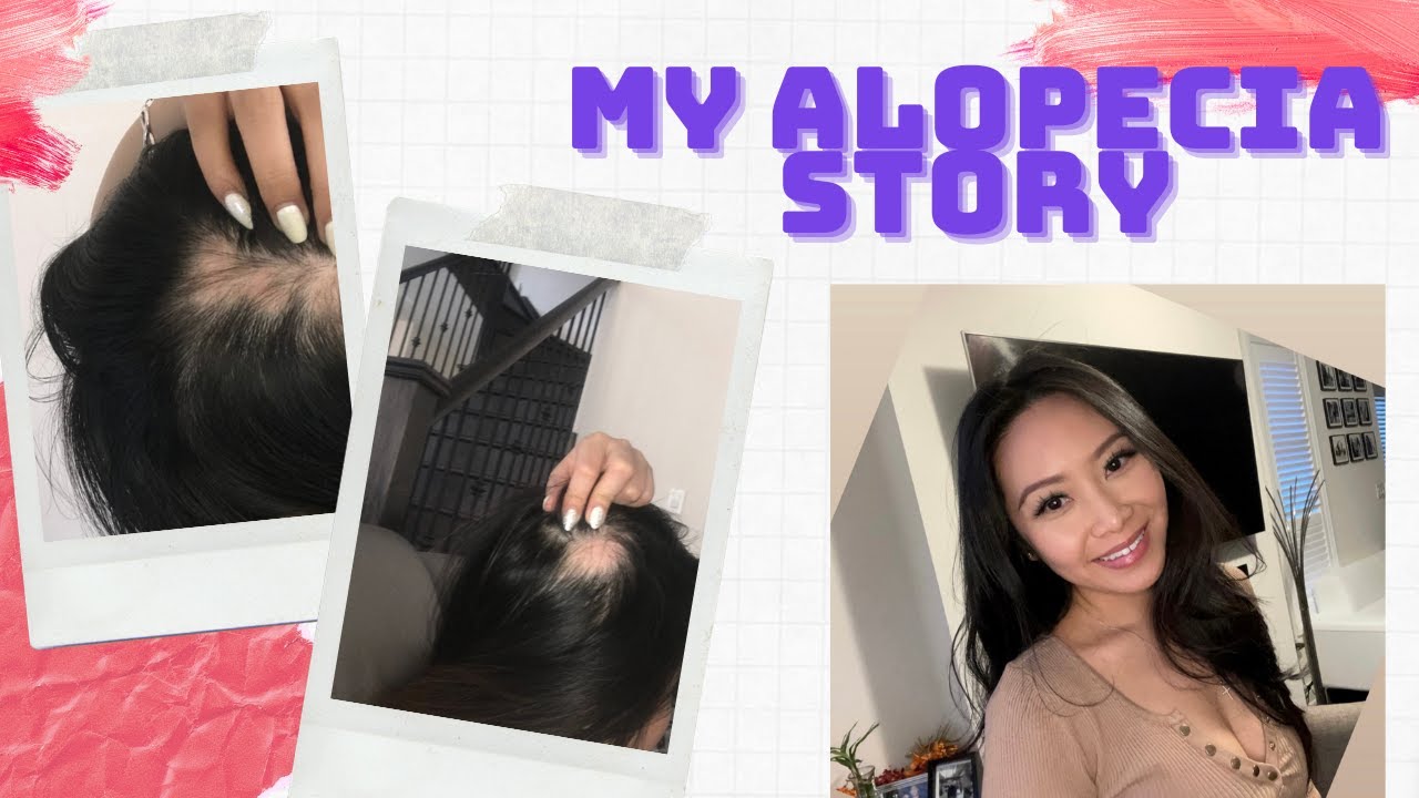 Story time: My Alopecia Experience (with photos)