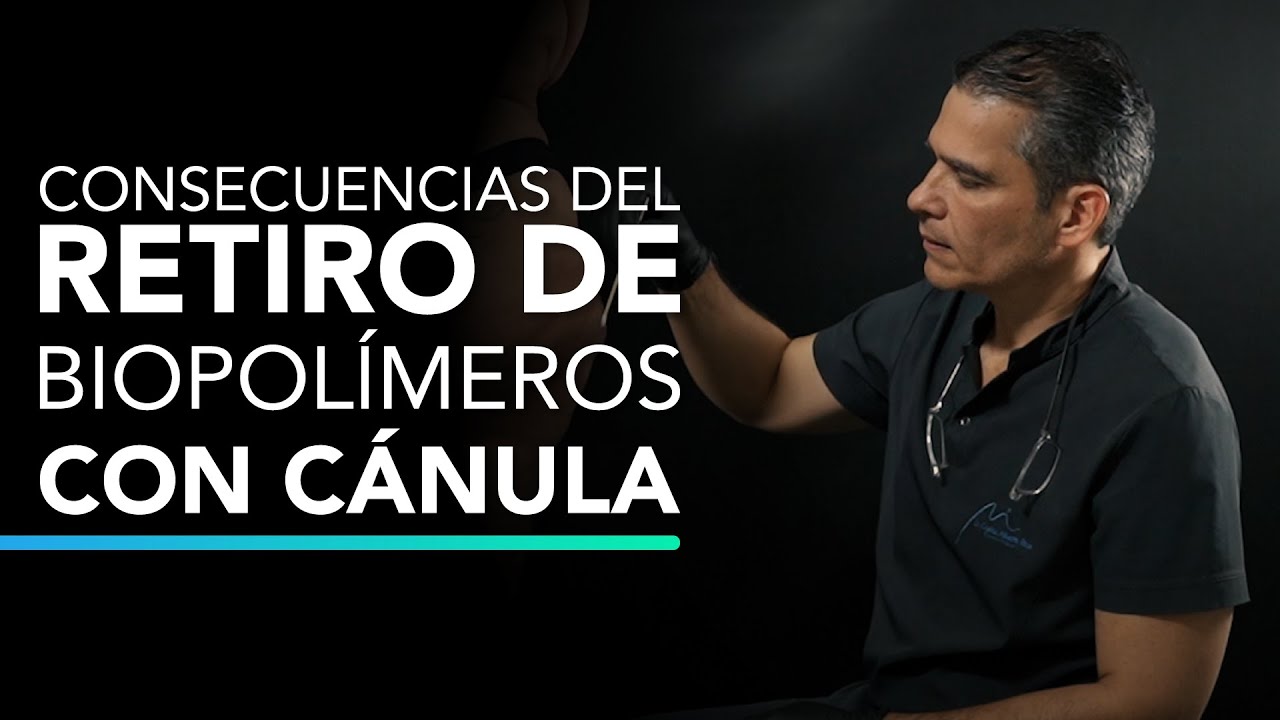 Caso Clínico: Consecuencias del retiro de biopolímeros con cánulas