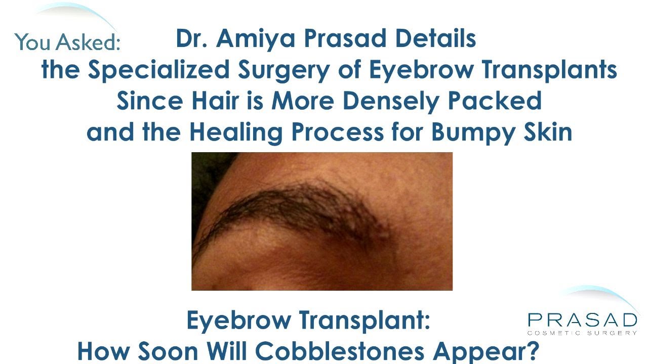 Why Eyebrow Transplants are Highly Specialized and Why Bumpy Skin can Appear During Healing