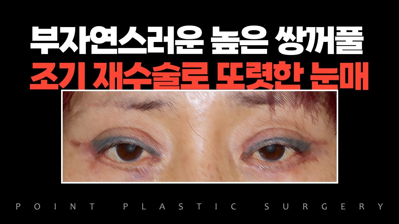 [눈성형/수술전후] 쌍꺼풀수술실패 조기재수술 눈매교정 재수술