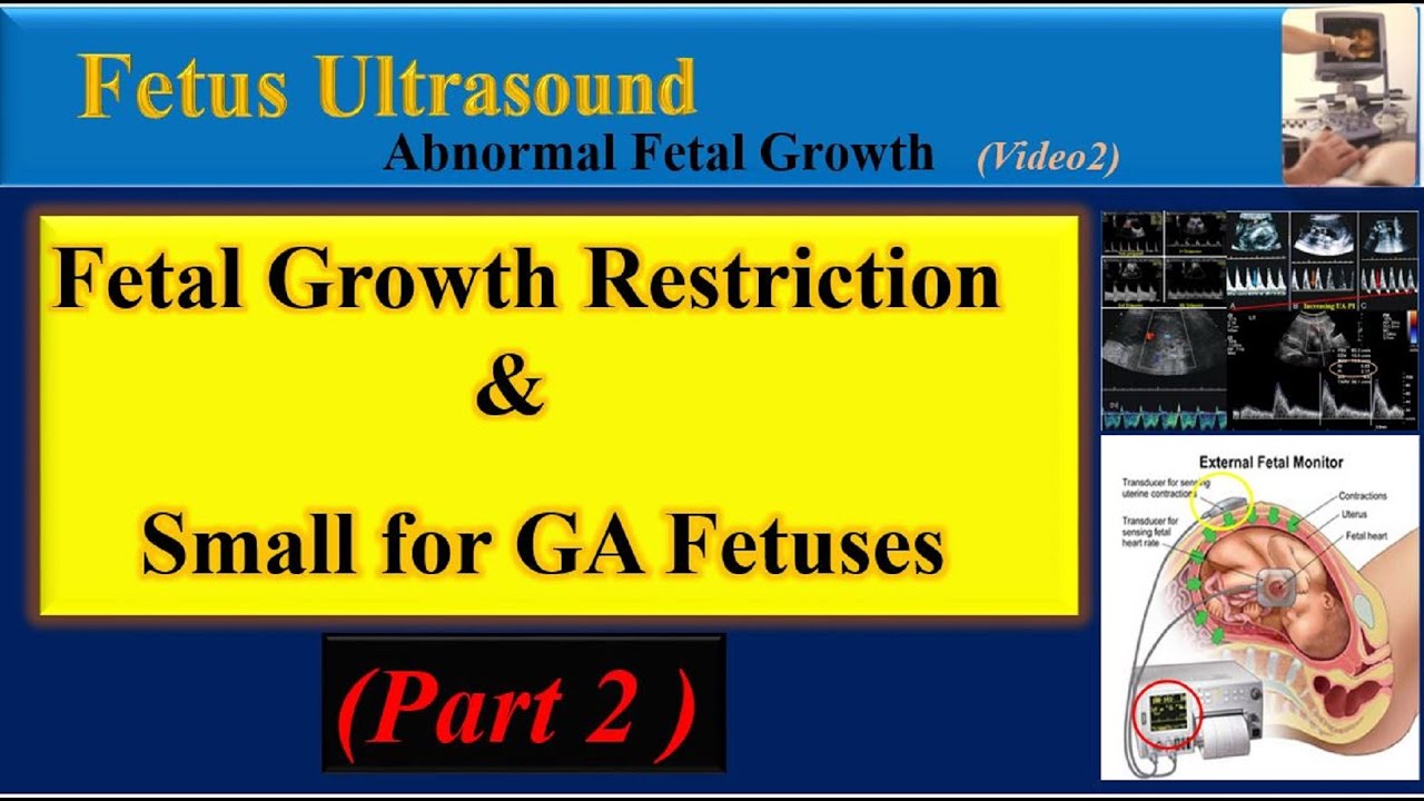 Fetus Ultrasound, Fetal Growth Restriction and  Small for Gestational Age Fetuses Part2