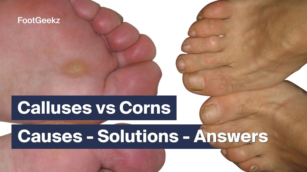 Calluses vs Corns - Causes - Solutions - Answers