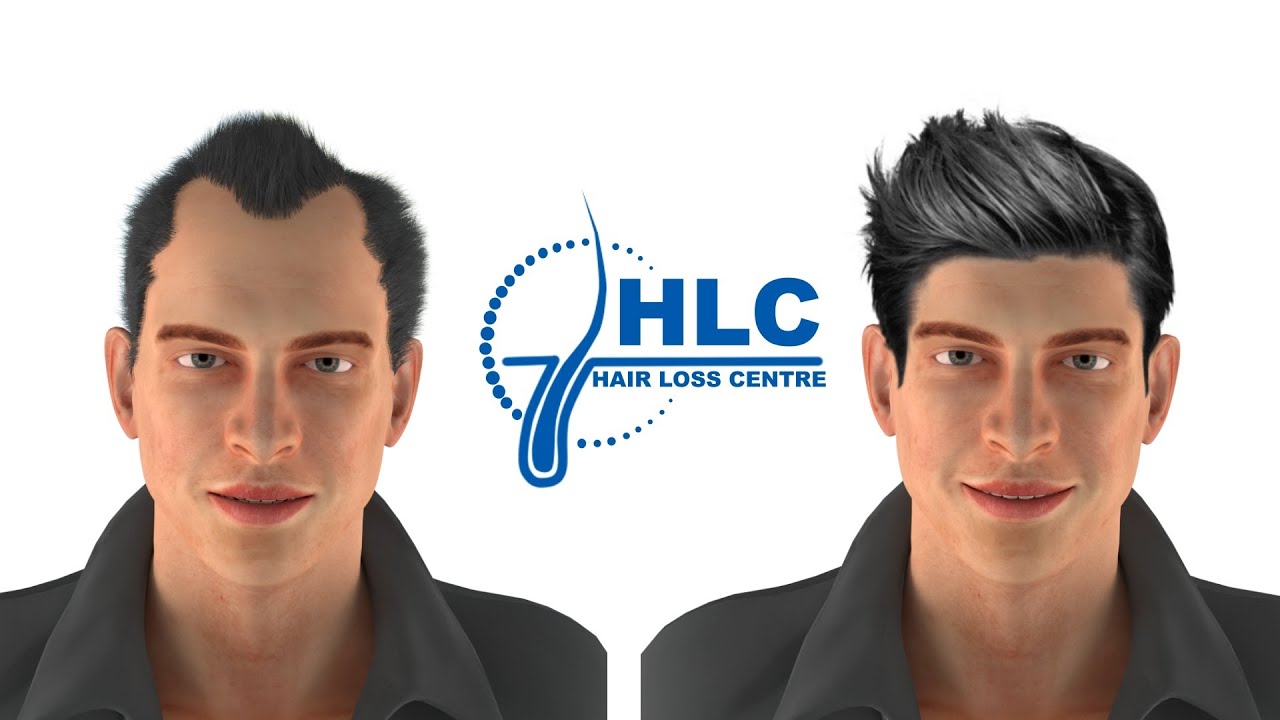 Hair transplant explainer 3d animation- Follicular unit extraction FUE