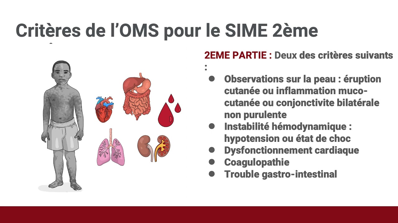 15b Le syndrome inflammatoire multi-systémique chez l’enfant (SIME)