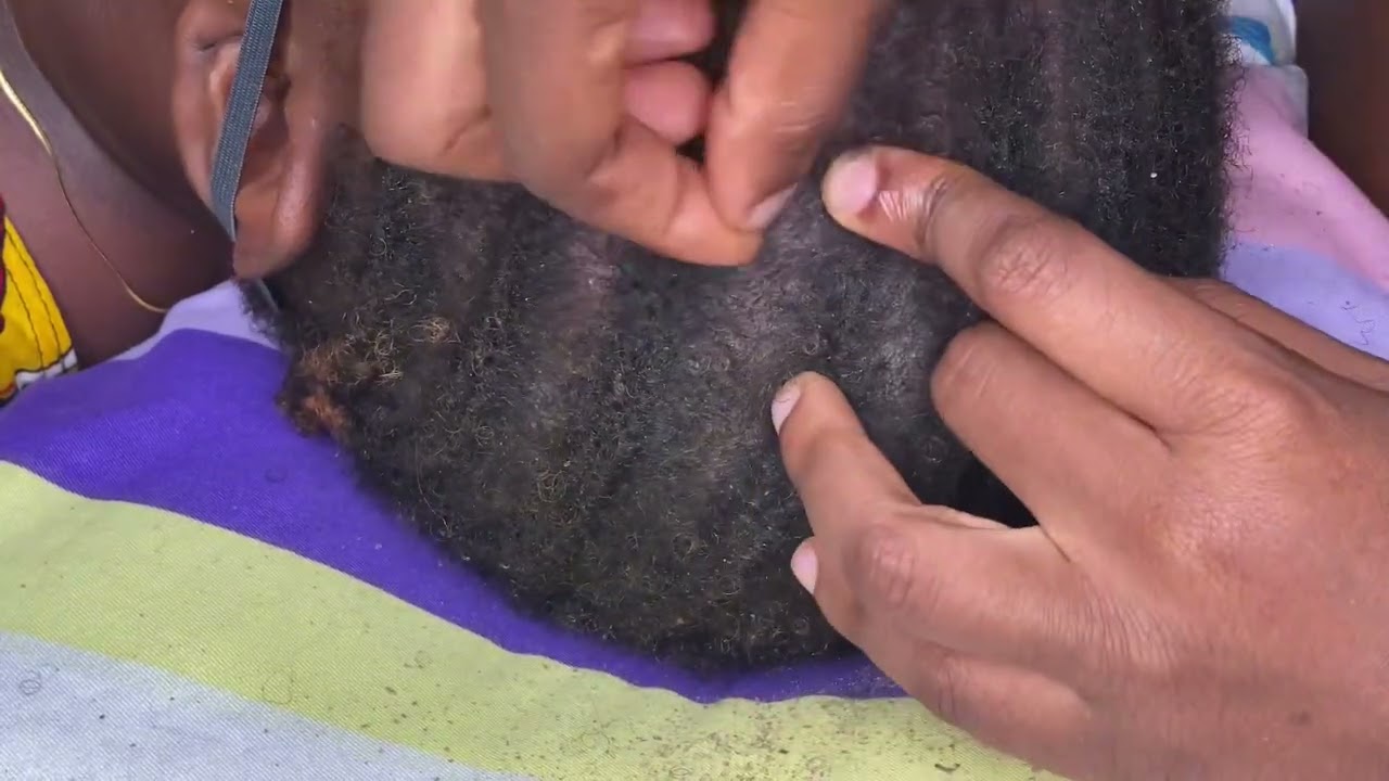 NITPICKING SCALP WITH BARE FINGERS || EXTREMELY SATISFYING