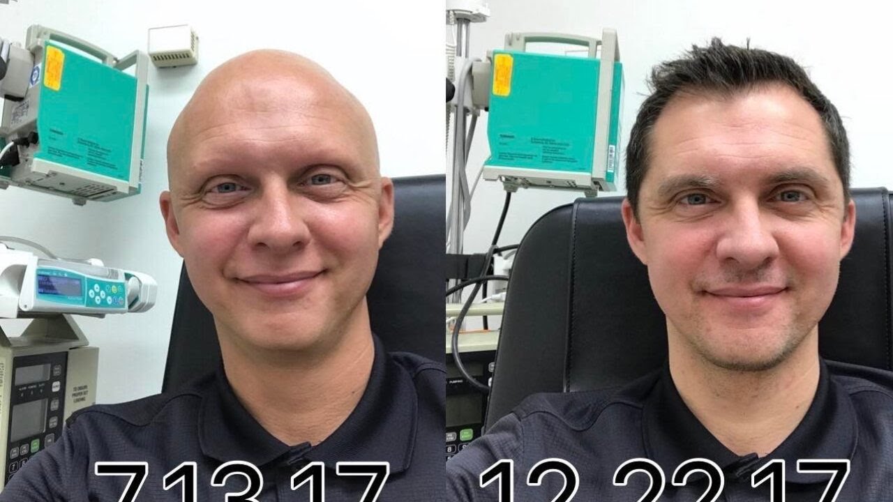 New drug for Alopecia sufferers brings hope to community