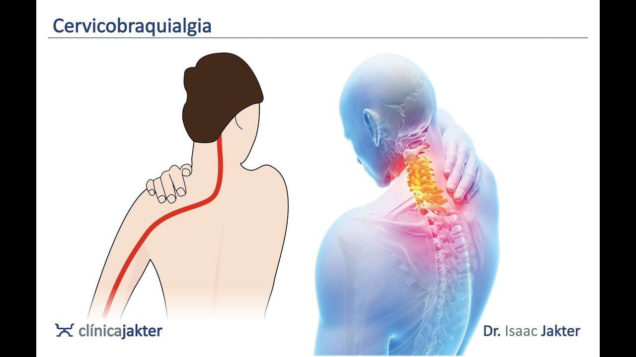 Dolores en los brazos (Cervicobraquialgia) 1 - Dr. Isaac Jakter