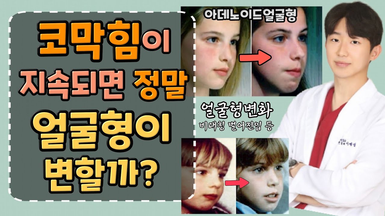 입 벌리고 자는 사람 주목!ㅣ비염, 아데노이드비대증ㅣ 얼굴형을 변하게 하는 코막힘 , 그 이유는?