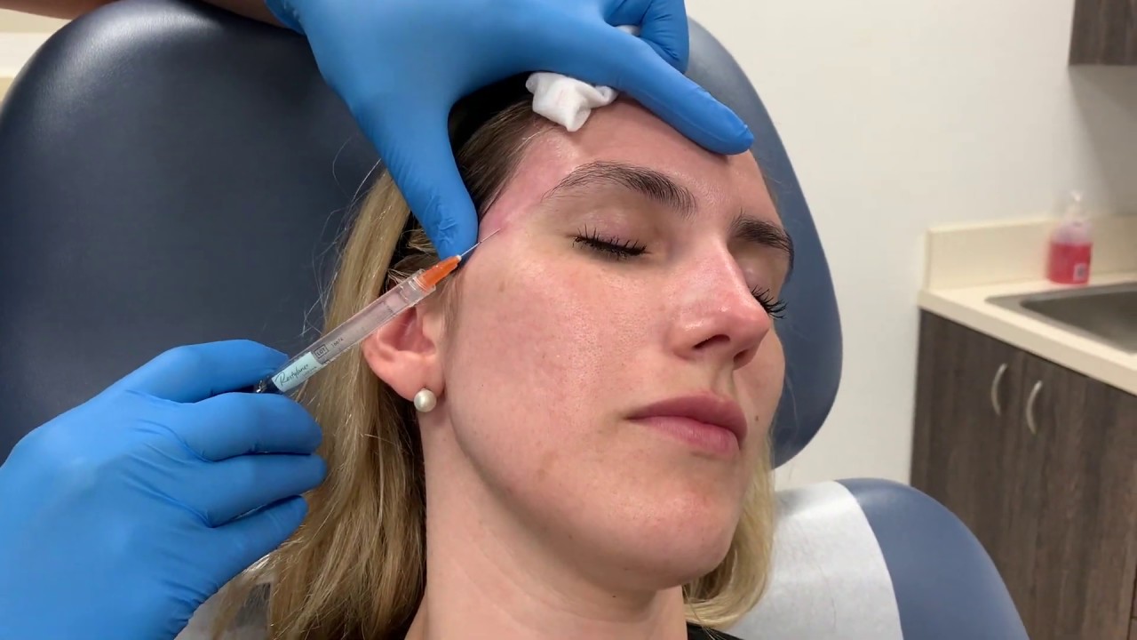 Treating temple volume loss using dilute Restylane Defyne and a microcannula by Dr. Shaun Patel