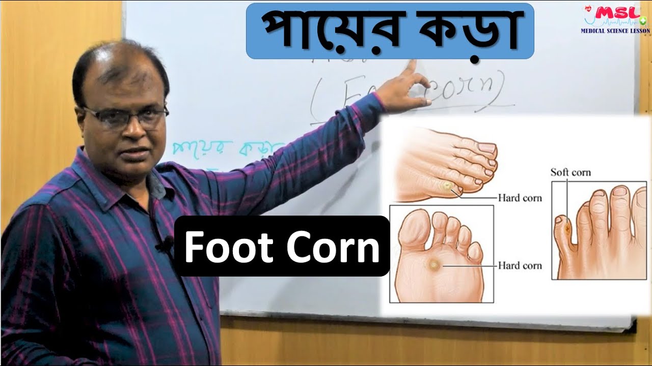 পায়ের কড়া - Foot Corn Bangla - Dr. Md. Abdul Mannan