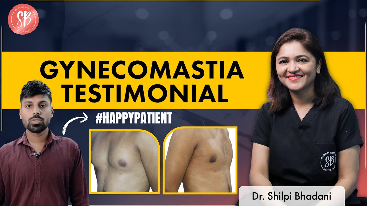 Gynecomastia testimonial | SB Aesthetics | Best Gynecomastia Surgeon in Gurgaon