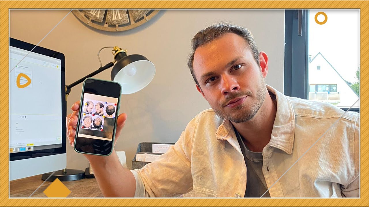 Meine Haartransplantation bei der Cosmedica Clinic