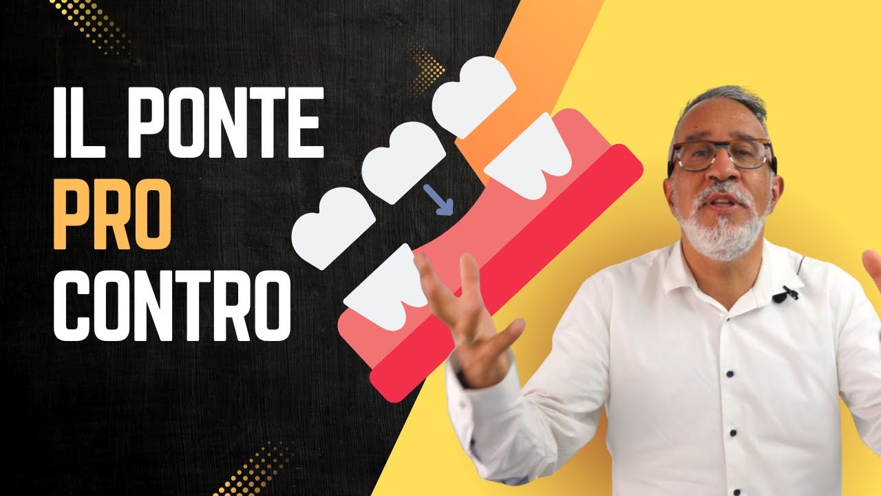 Ep.3 Alternativa agli impianti: ponte dentale PRO e CONTRO