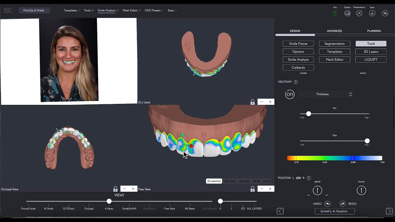 How to Create 3D Print-Ready Treatment Plans in Minutes