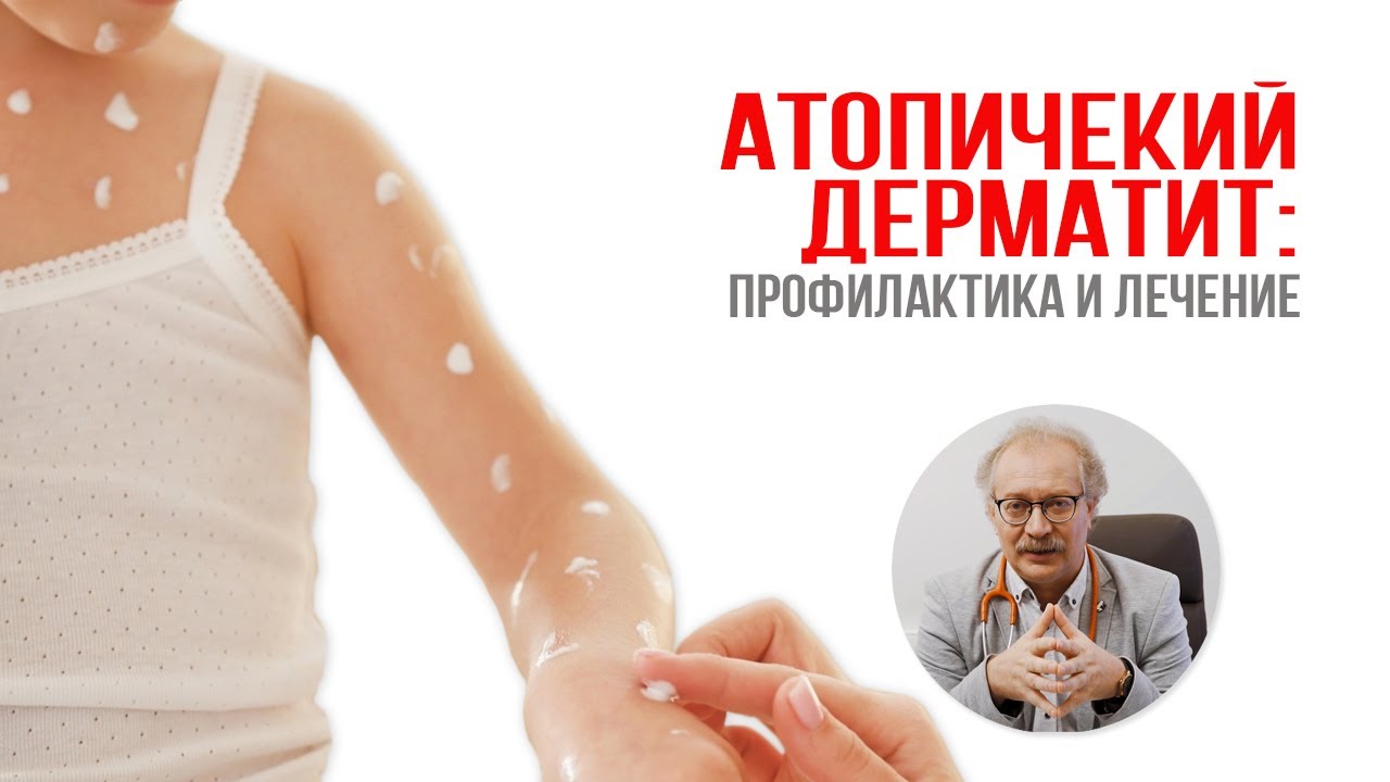 Атопический дерматит: профилактика и лечение