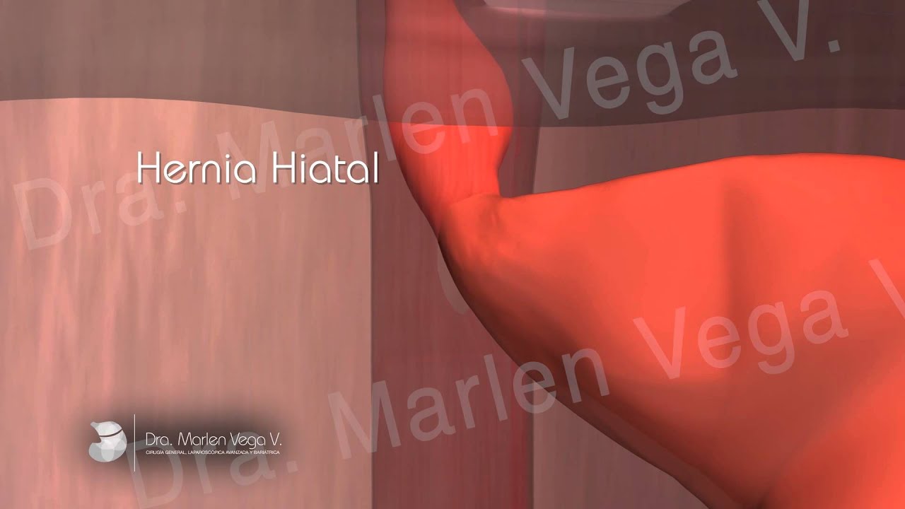 Dra. Vega: Cirugía de Hernia Hiatal – Video animado
