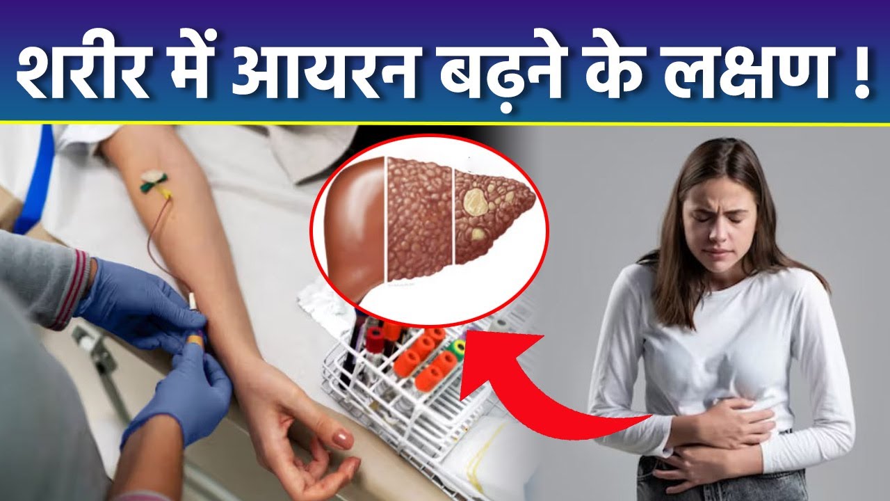 Hemochromatosis Symptoms & Treatment: Body Me Iron Badhne Ke Nuksan, Explained|Boldsky
