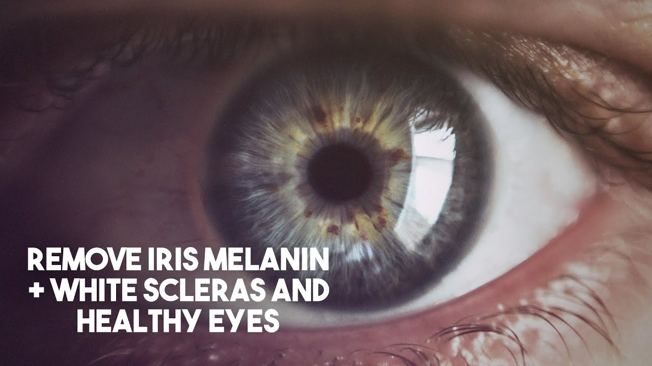 ∞ Remove Iris Melanin + White Scleras and Healthy Eyes ~ EXTREMELY POWERFUL 8D+ SUBLIMINAL [Night]