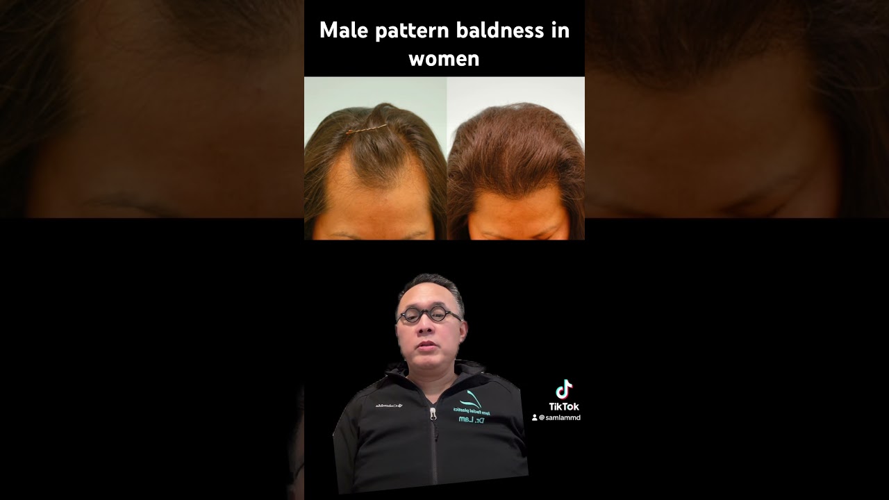 Male pattern baldness in women