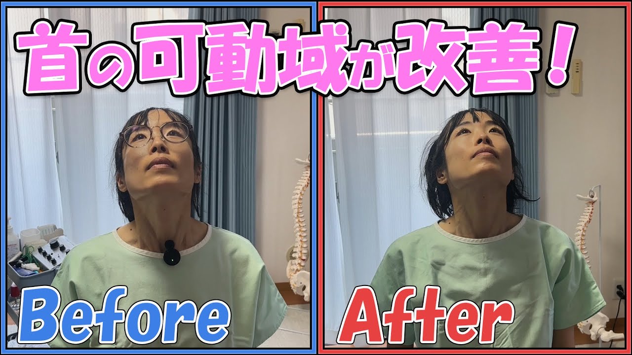 [首の可動域が改善！？]どこの接骨院に行っても改善しなかった首の痛みにカイロドクターが挑む！[大宮中央カイロプラクティック]