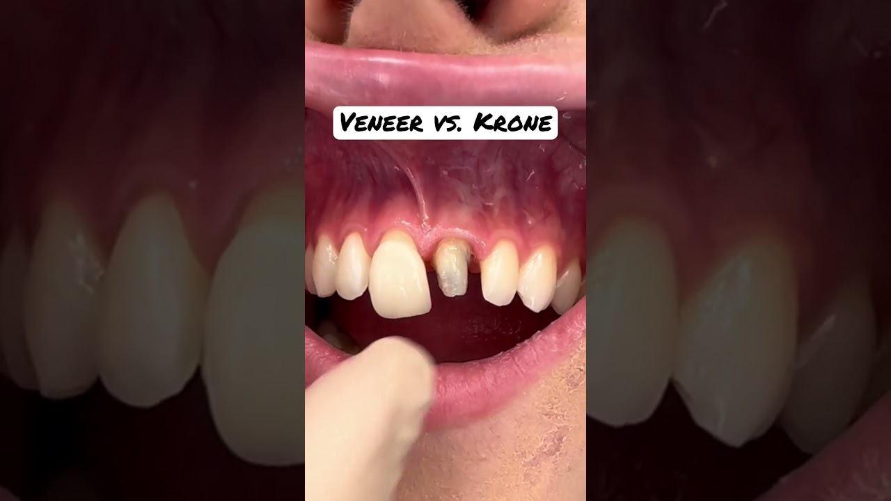 Veneer vs. Krone #veneers #zahnkrone #zahnersatz #sch&ouml;nez&auml;hne #zahnarzt