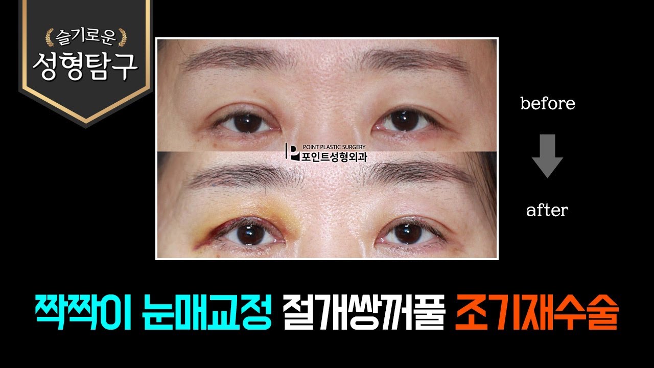 짝짝이 눈매교정 절개쌍꺼풀 조기재수술