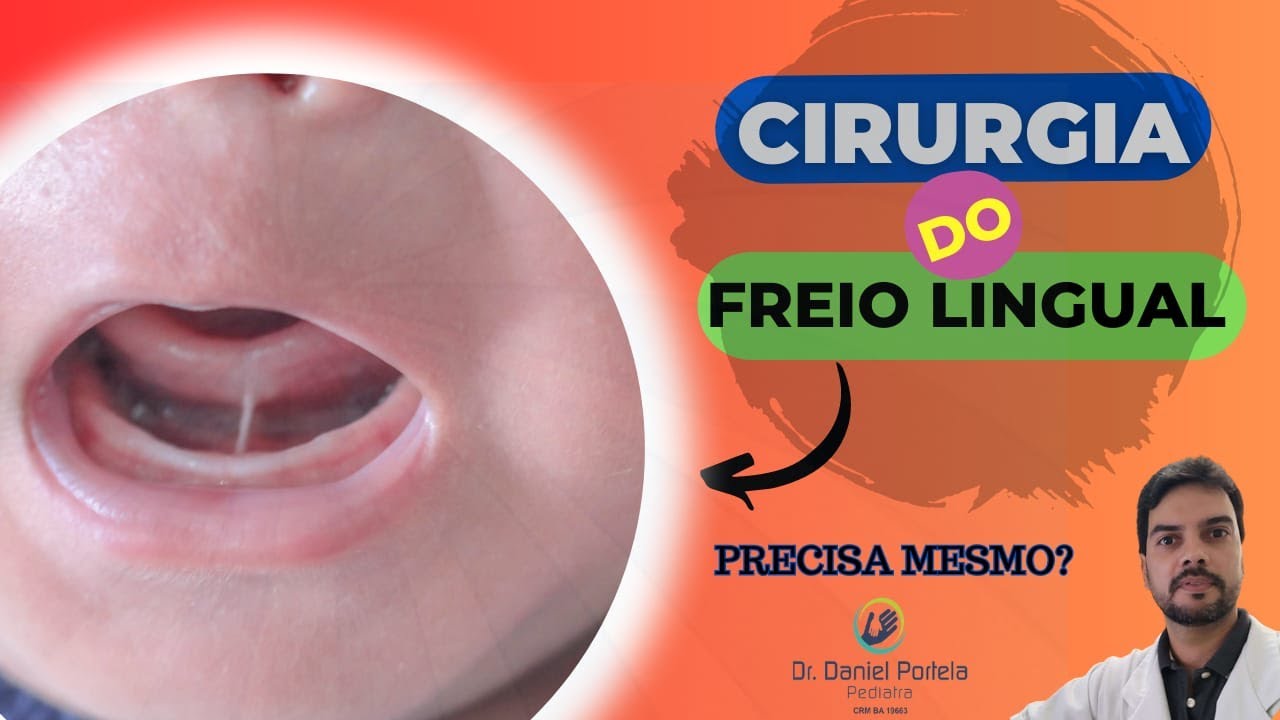 CIRURGIA DO FREIO LINGUAL: precisa mesmo?
