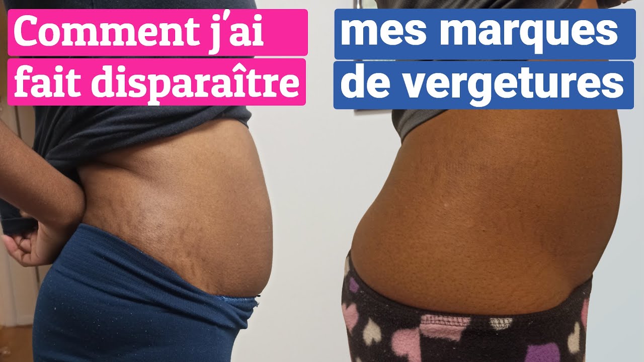 COMMENT FAIRE DISPARA&Icirc;TRE LES VERGETURES | MES SOLUTIONS !