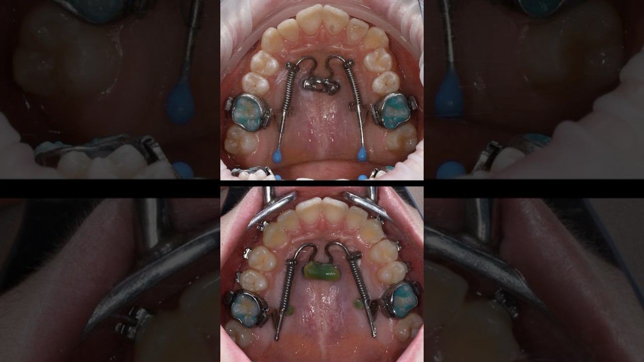 Работа на Дистализаторе #beneslider #ортодонтмосквадильфуза#orthodontistdilfuza #брекетымосква