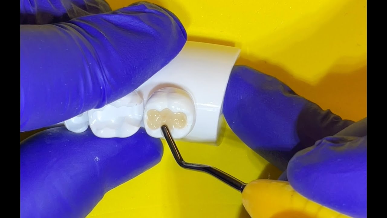 Demo Resinas Bulk - Fill (Dientes Posteriores)