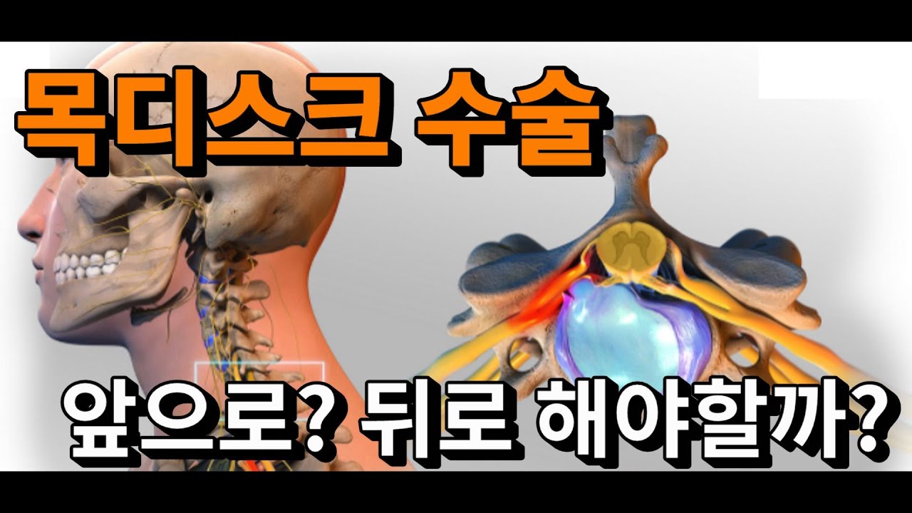 '목디스크 수술' 고민중이신 분들은 보세요. 그림으로 쉽게 설명해 드립니다.