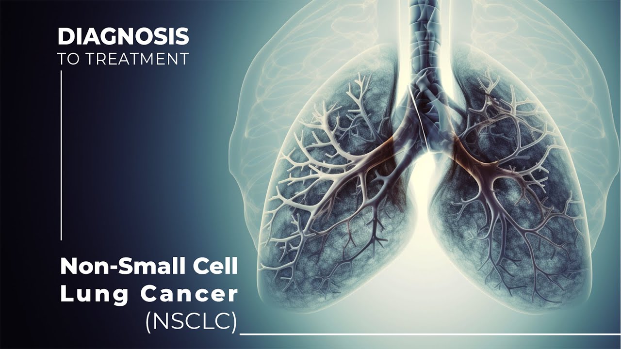 Какие варианты лечения существуют: рак легких и немелкоклеточный рак легких (НМРЛ)
