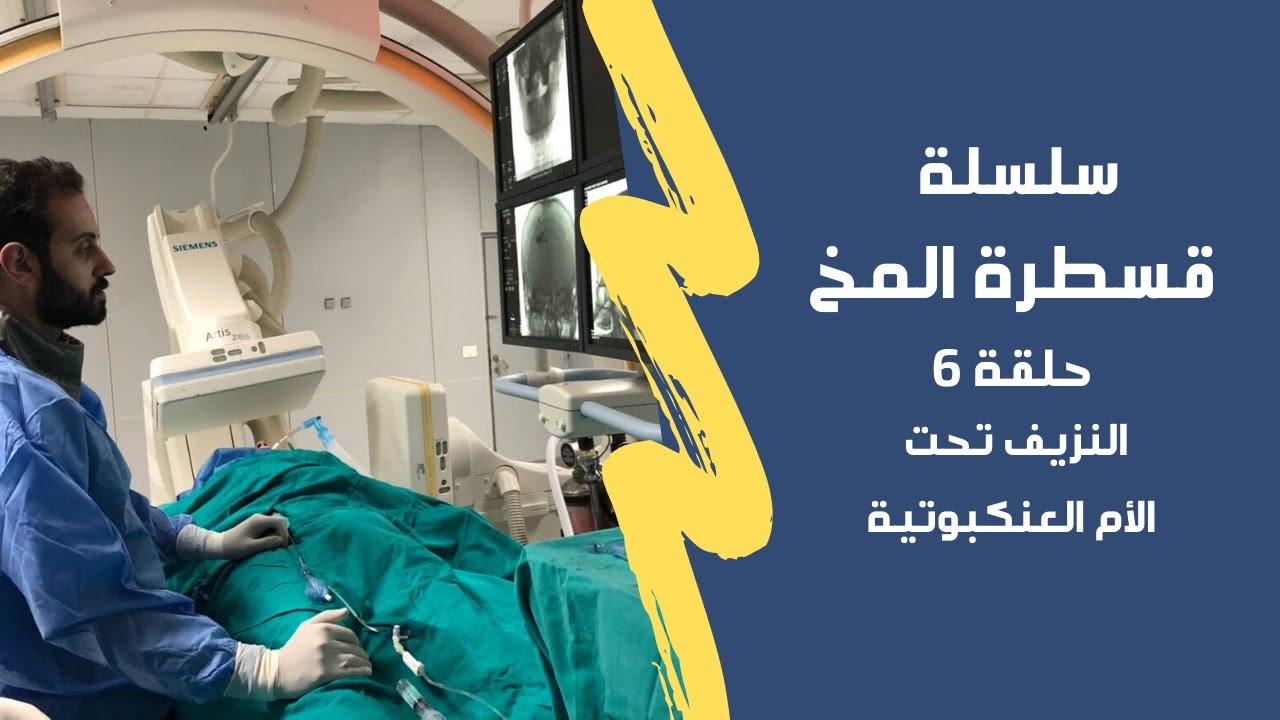 الحلقة ٦ سلسلة قسطرة المخ : النزيف تحت الام العنكبوتية بسبب التمدد الشرياني في المخ