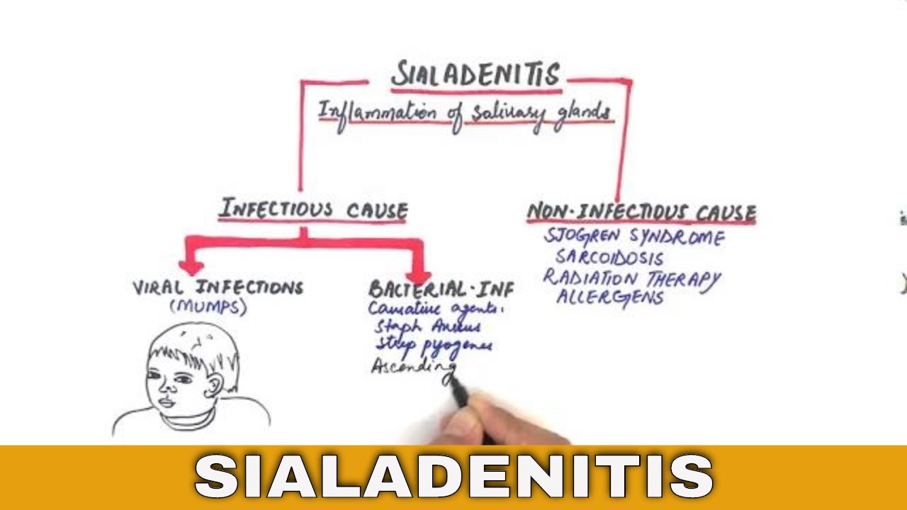 Sialadenitis - Causes, Clinical features, Treatment (Chronic and Acute Bacterial Sialadenitis)