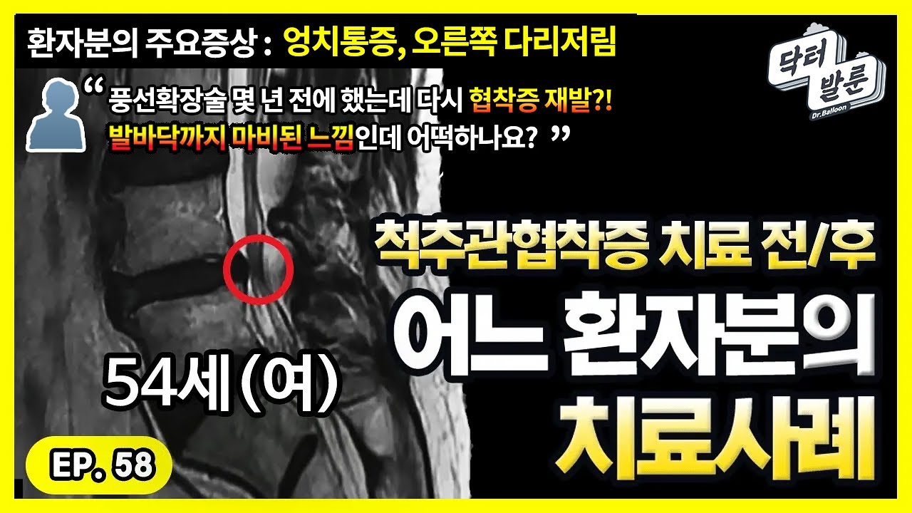 【환자사례】협착증 다리저림으로 10m 걷는 것조차 버거워하셨던 상황.. ✔54세 환자분 사례로 알아보는 척추관협착증 완치사례ㅣ닥발TV