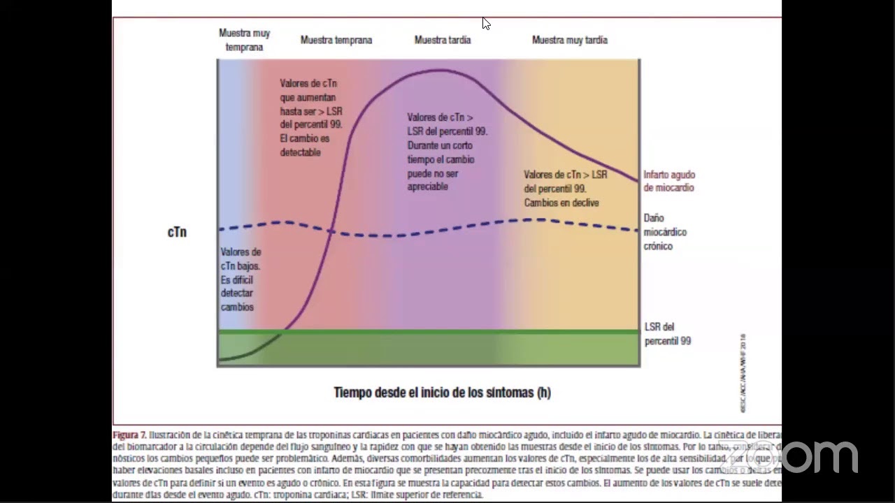 Webinar de Cardiolog&iacute;a 4&ordm; Definici&oacute;n Universal del Infarto de Miocardio. Revisi&oacute;n