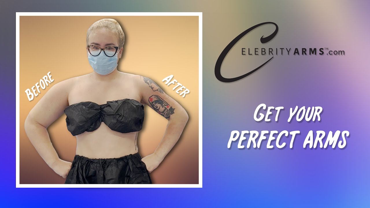 Celebrity Arms&trade; | Lipo 360&deg; | Forearm Liposuction | High-Definition | Expert Dr. Thomas Su