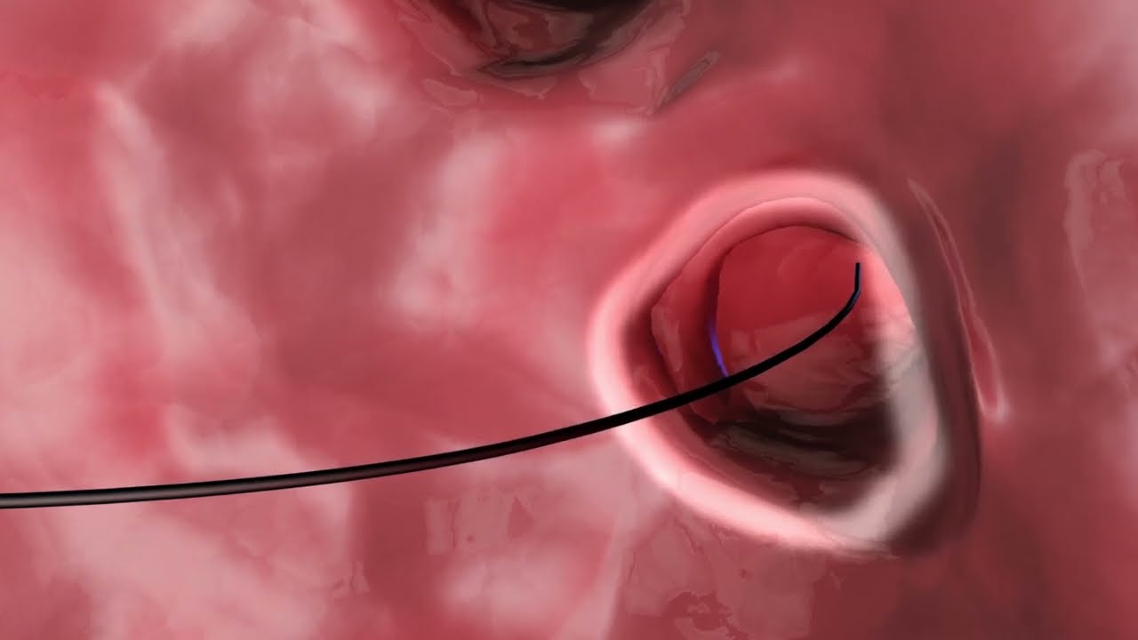 Healium Medical: Image Guided Ablation Procedure - Animation Video